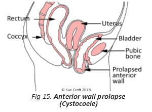 Overactive Bladder & Prolapse